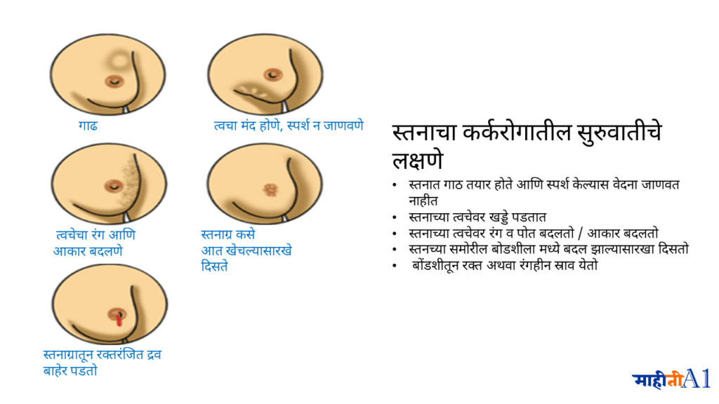 breast cancer