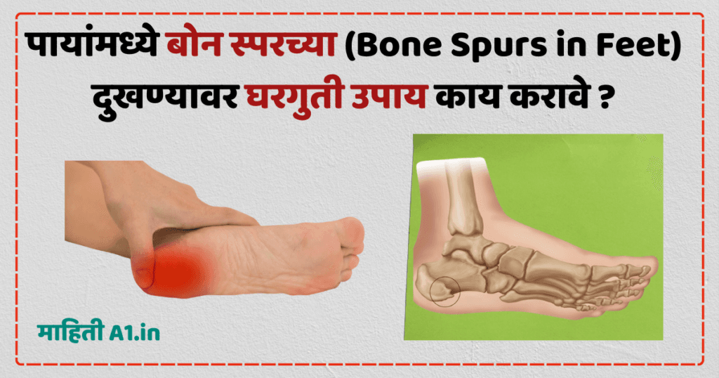 Bone Spurs in Feet