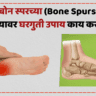 Bone Spurs in Feet